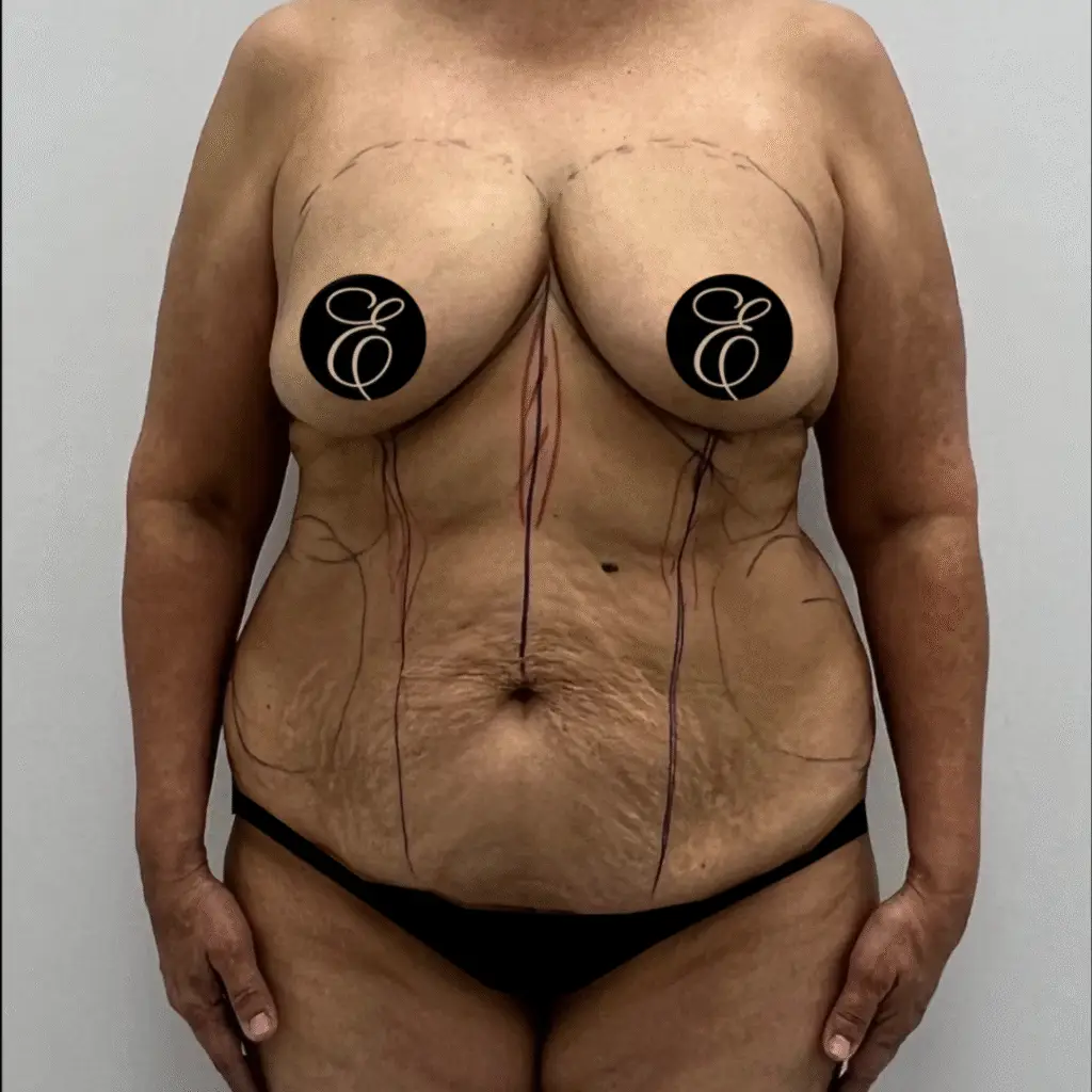 Woman with loose abdominal skin before treatment – RF microneedling for body before and after Calabasas