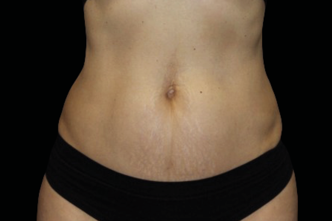 After abdominal treatment – Non-surgical skin tightening abdomen after