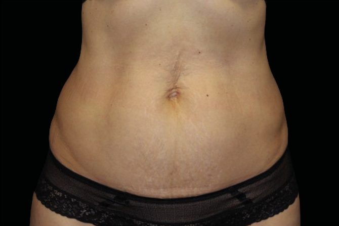 Before abdominal skin tightening – Non-surgical skin tightening abdomen before