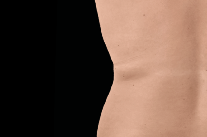 After double chin reduction – RF microneedling for face after treatment