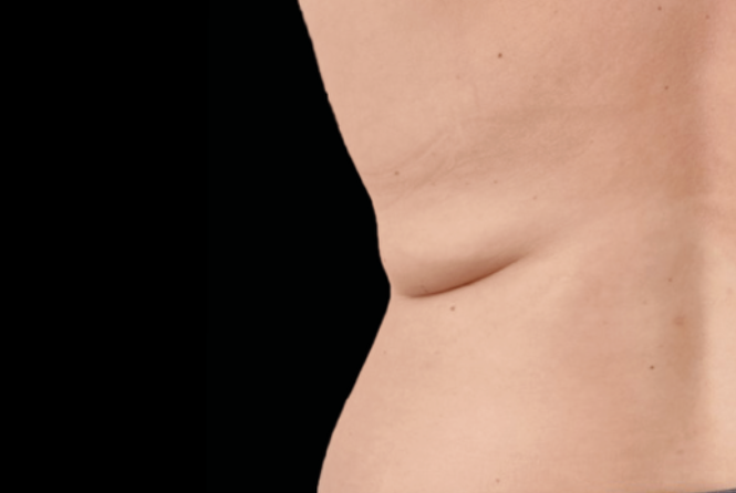Before double chin – RF microneedling for face before treatment