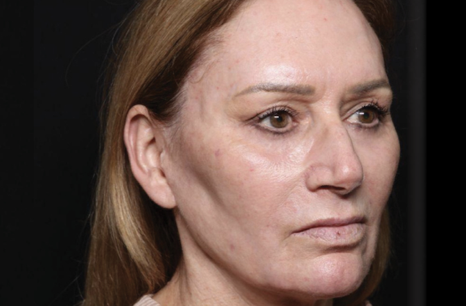 Woman with uneven facial texture before treatment – Microneedling for fine lines and wrinkles before Calabasas