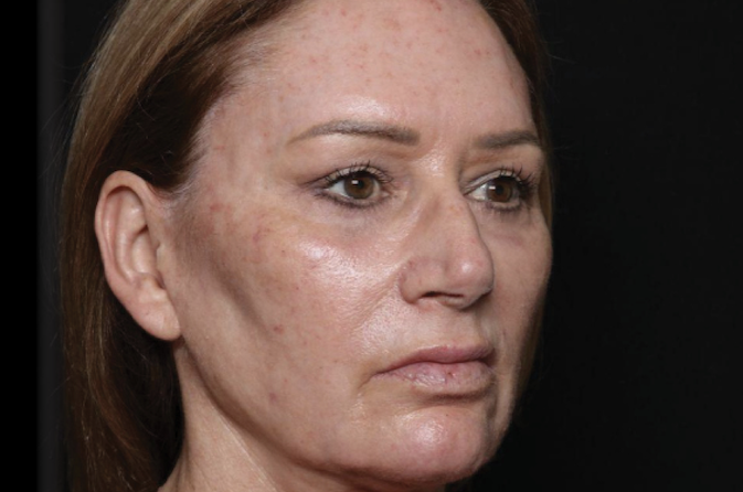 Woman with sagging skin before rejuvenation – Exion RF microneedling for face tightening before
