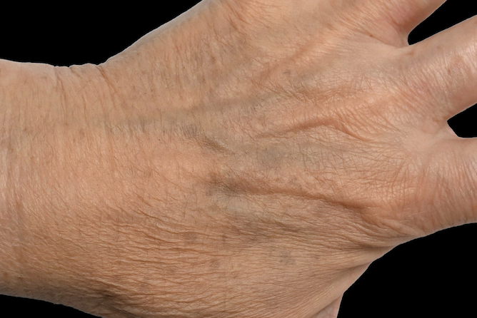 Aged hand before rejuvenation – Non-surgical skin rejuvenation for aging hands Calabasas