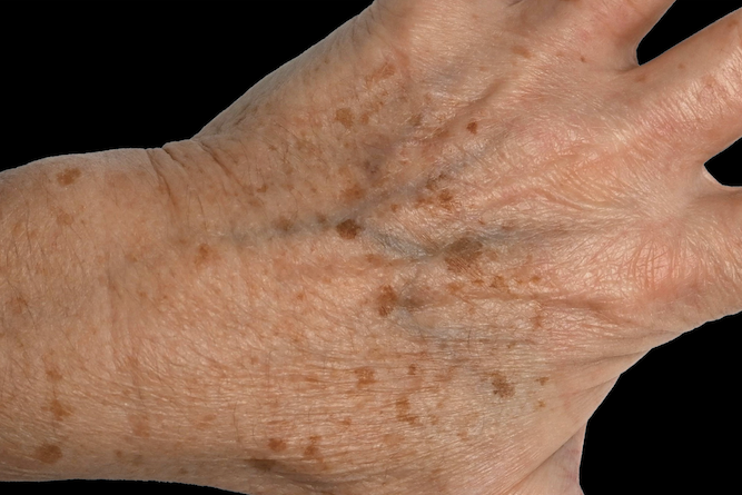Aged hand with dark spots – Skin tightening and pigmentation treatment Calabasas