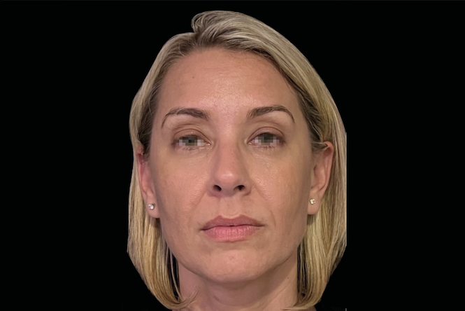 Before treatment photo of woman – RF microneedling face before treatment