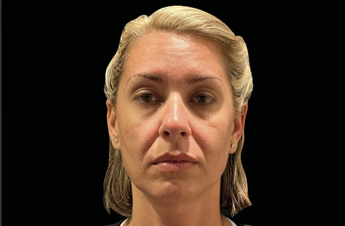 Before treatment photo of woman’s face – Microneedling with exosomes before and after