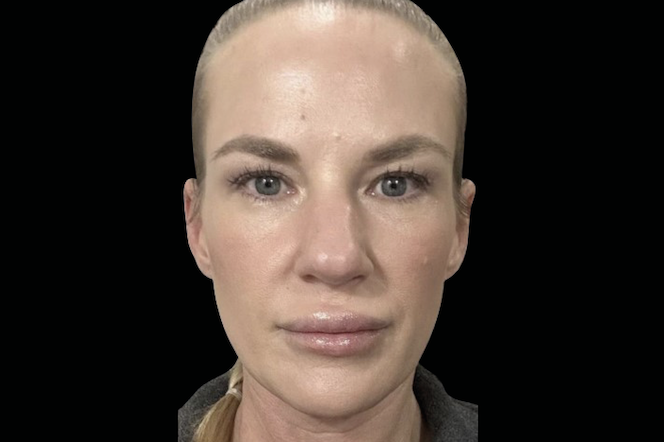 Before treatment photo of woman – Exion face non-surgical rejuvenation before