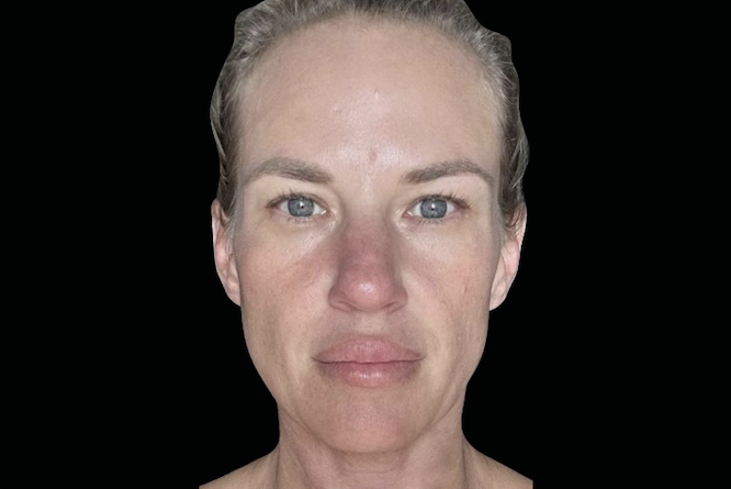 Fine lines and wrinkles treatment Calabasas