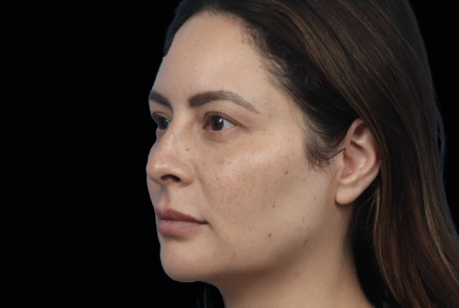 After treatment side profile woman – After microneedling Calabasas