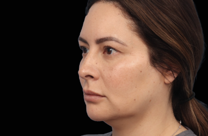 Before microneedling Calabasas