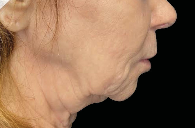 Before sagging neck and jawline – Skin tightening treatment before Calabasas