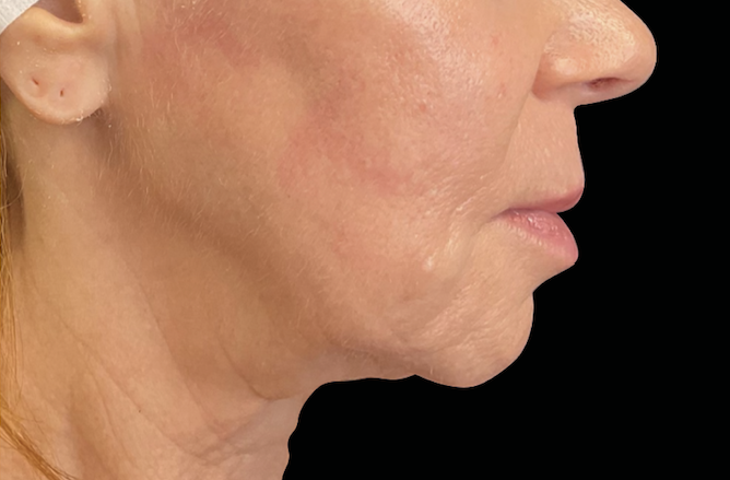 After jawline tightening – Skin tightening after RF microneedling Calabasas