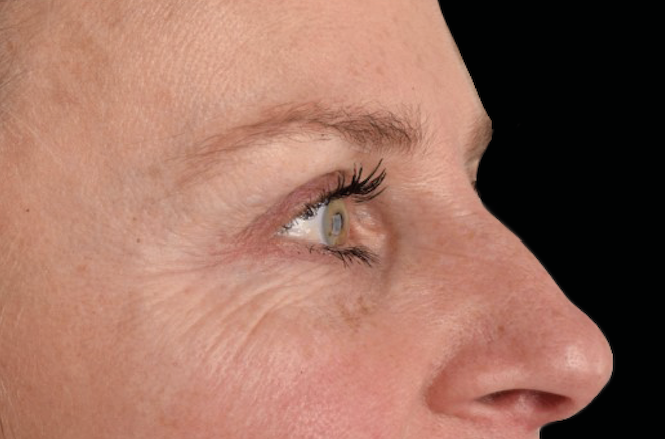 Eye wrinkles after treatment – Microneedling for fine lines after treatment