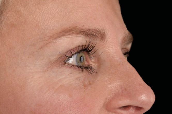 Eye wrinkles before treatment – Microneedling for fine lines before treatment