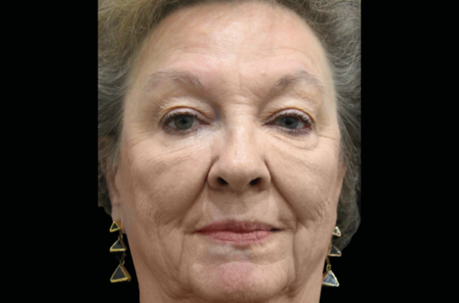 Mature woman face after treatment – Skin rejuvenation treatment for aging skin Calabasas