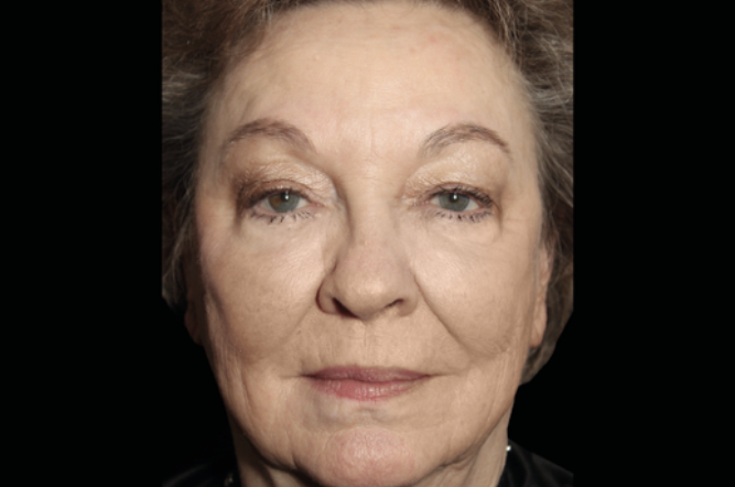 Elderly woman before rejuvenation – Before non-surgical facial rejuvenation Calabasas