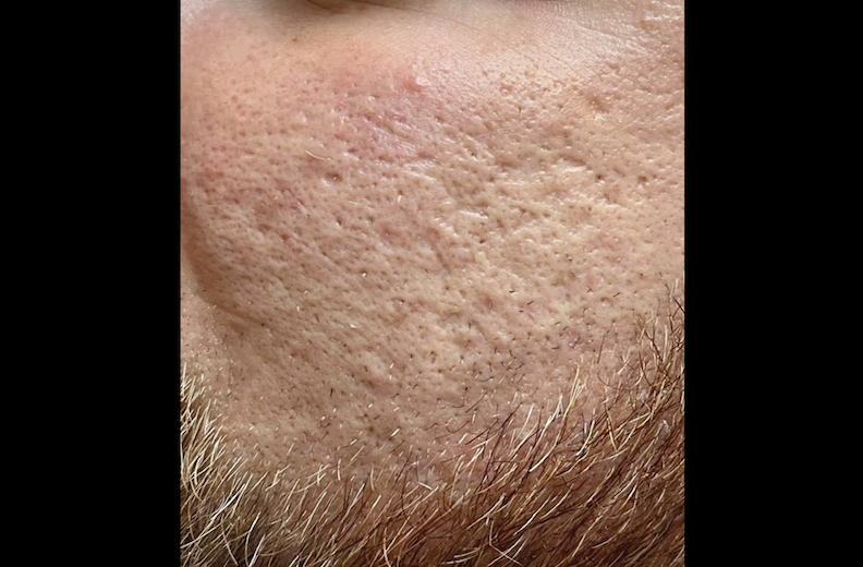 Acne scars close-up before treatment – Acne scars treatment Calabasas before