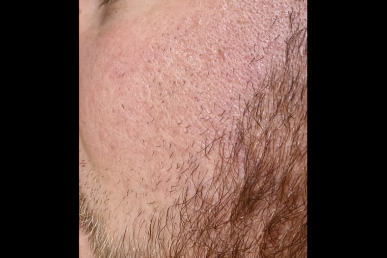 Acne scars close-up after treatment – Acne scars treatment Calabasas after
