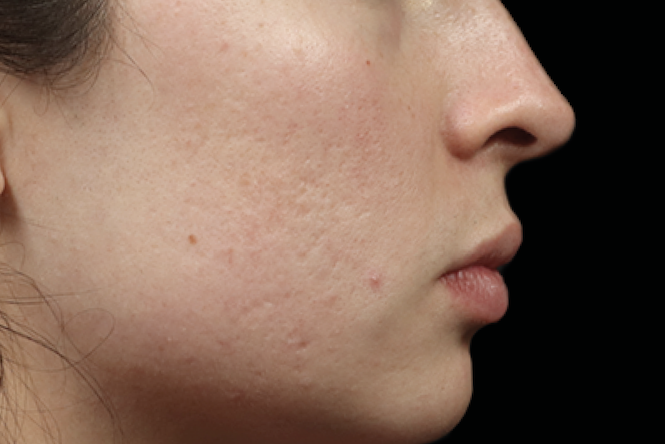 Chin acne scars before treatment – Microneedling acne scars before Calabasas
