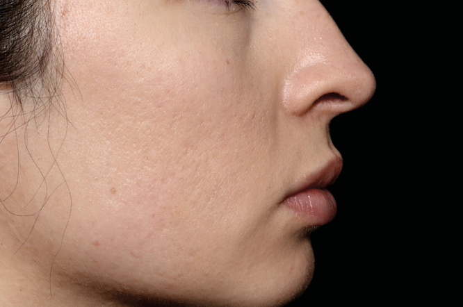 Chin acne scars after treatment – Microneedling acne scars after Calabasas