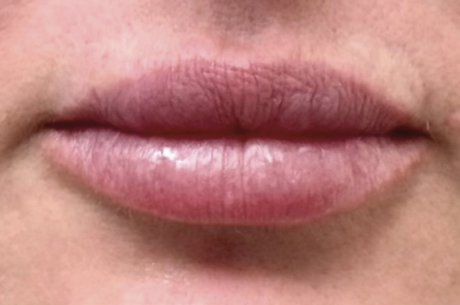 Lips before filler treatment – Lip filler Calabasas before