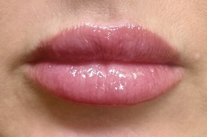 Lips after filler treatment – Lip filler Calabasas after